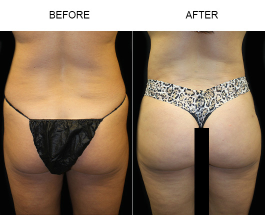 Before And After Brazilian Butt Lift