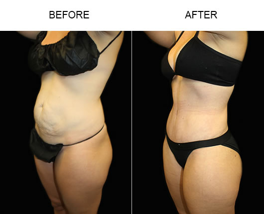 LowCut Tummy Tuck Before & After