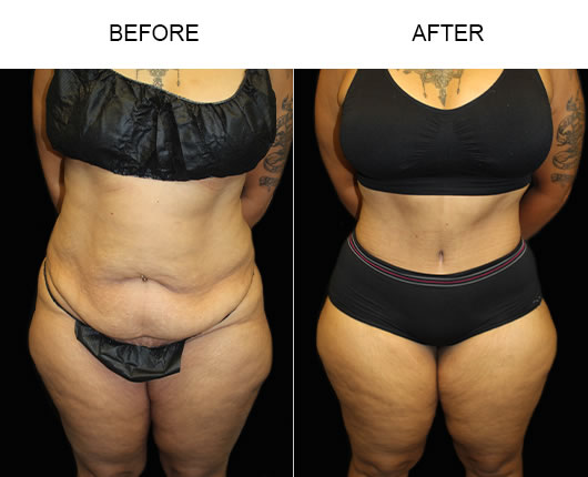 Low Cut Tummy Tuck Before And After