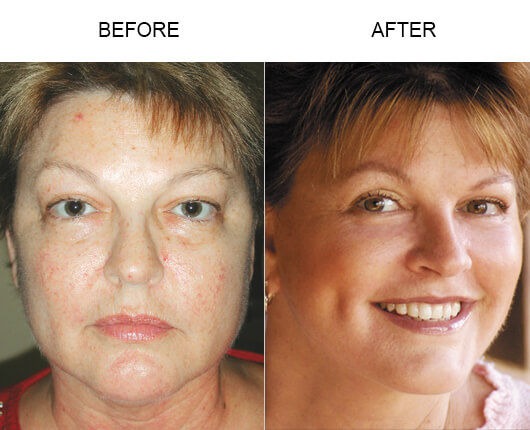 Facelift Before And After 