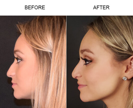 Orlando Before And After Rhinoplasty Surgery