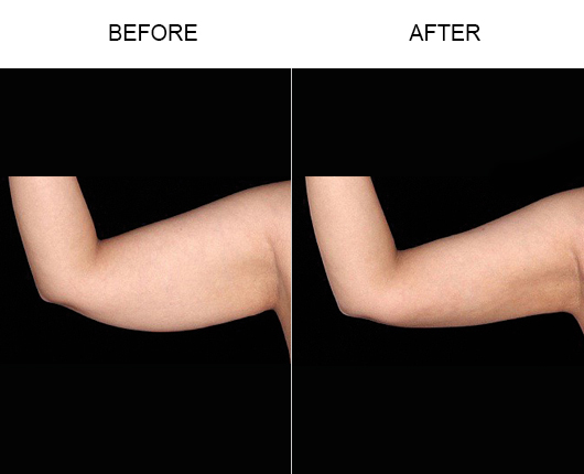 Bodytite Before And After