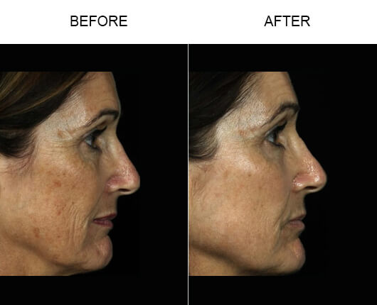 Fraxel Laser Treatment Before And After