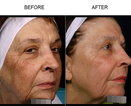 Facial Laser Treatment Before And After
