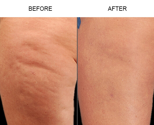 Cellulaze™ Cellulite Treatment Before And After