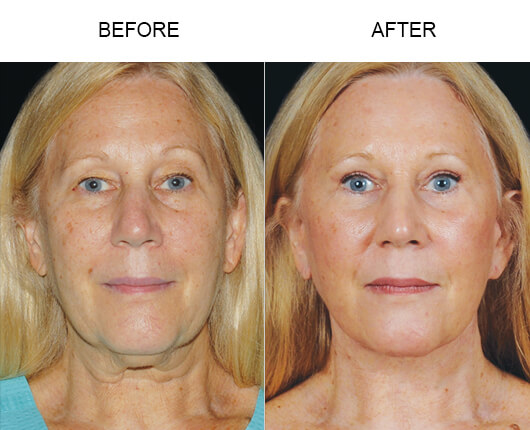 Mini Facelift Surgery Before And After Mini Facelift Surgery Before And After