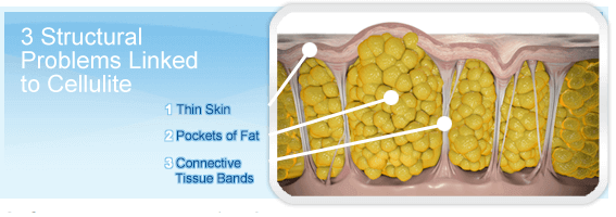 Cellulite Before Cellulaze™ Treatment Cellulite Before Cellulaze™ Treatment