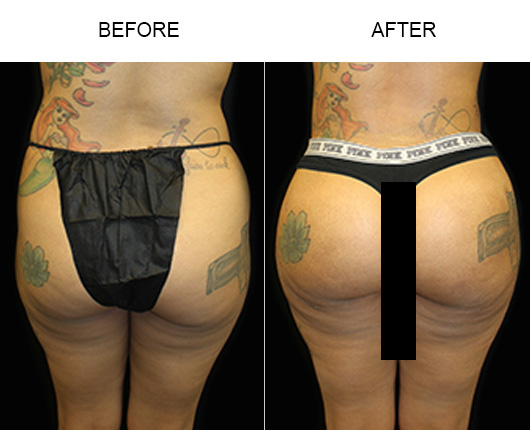 Brazilian Butt Lift Before And After