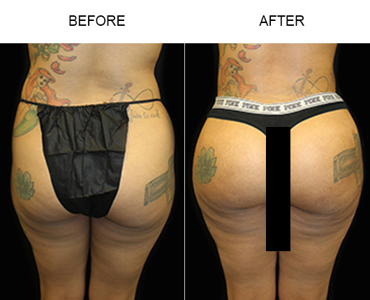 Brazilian Butt Lift Before And After Brazilian Butt Lift Before And After