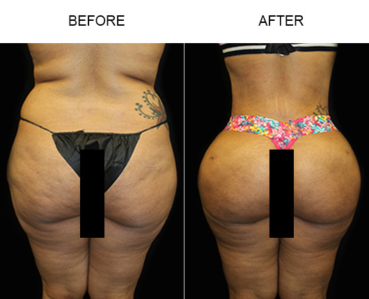 Brazilian Butt Lift Before & After