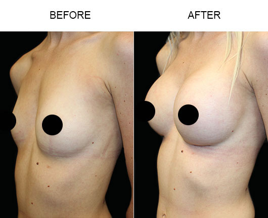 Breast Augmentation Results Breast Augmentation Results