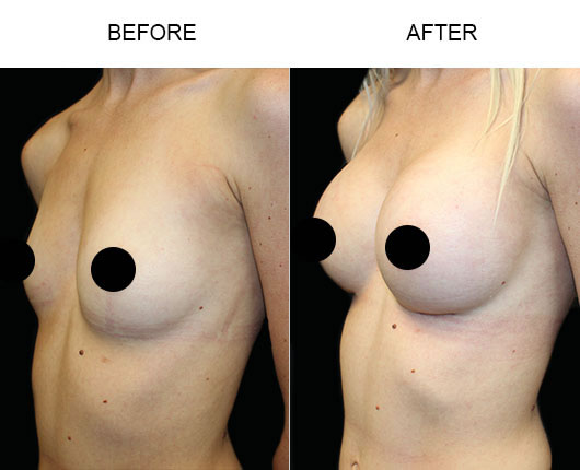 Breast Augmentation Results