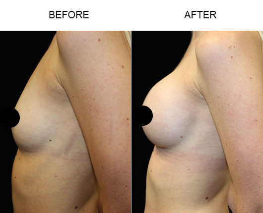 Breast Augmentation Surgery Before And After