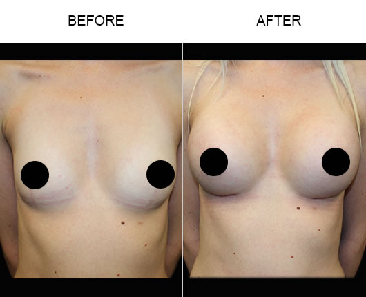 Breast Augmentation Before And After