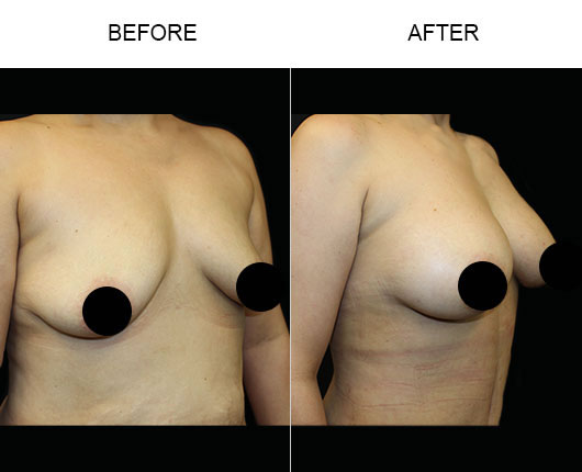 Breast Augmentation Surgery Before & After Breast Augmentation Surgery Before & After