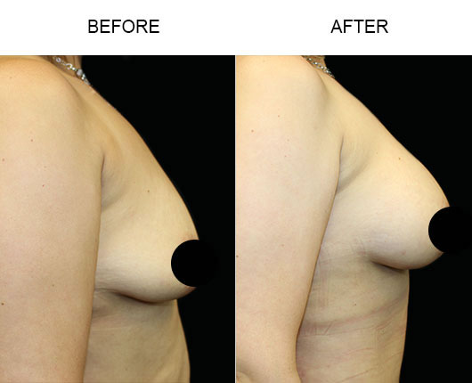 Before And After Breast Augmentation Surgery Before And After Breast Augmentation Surgery