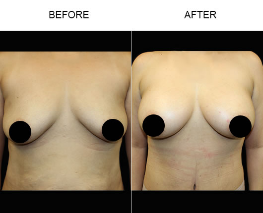 Breast Augmentation Before & After