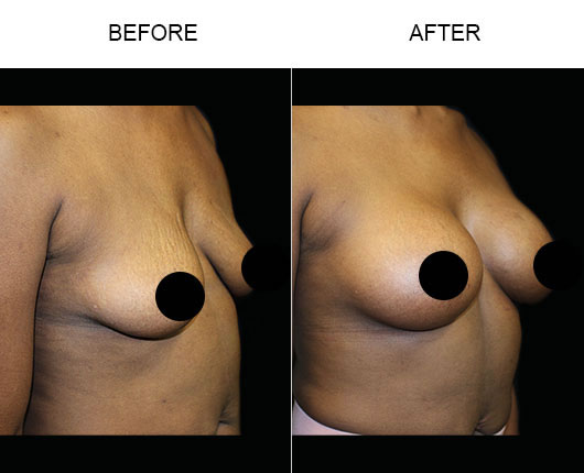 Before & After Breast Augmentation Surgery
