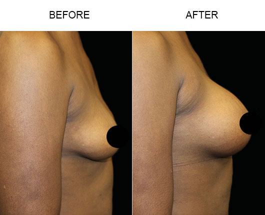 Breast Augmentation Surgery Results