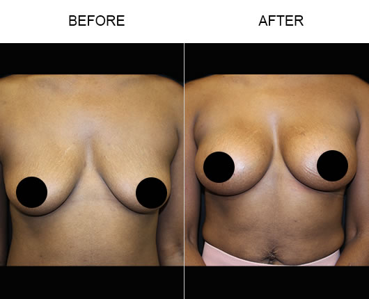 Before And After Breast Augmentation