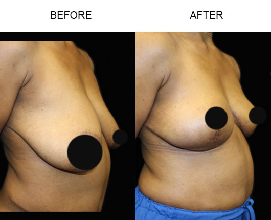 Before And After Breast Lift