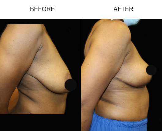 Before & After Breast Lift Before & After Breast Lift