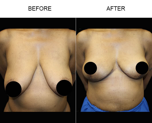 Breast Lift Before And After