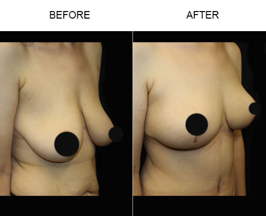 Breast Lift Results