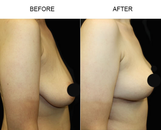 Breast Lift Surgery Before And After Breast Lift Surgery Before And After