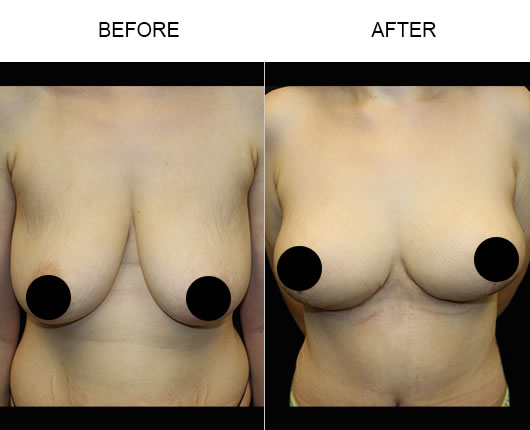 Breast Lift Before & After