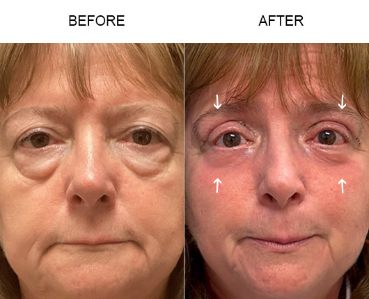 Upper Eyelid Surgery Before & After