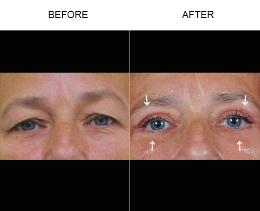 Blepharoplasty Surgery Before And After