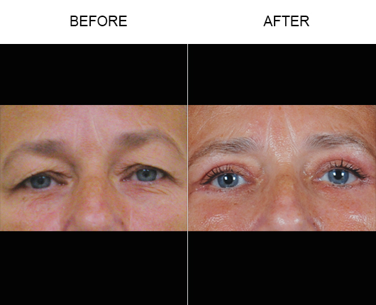 Upper Eyelid Surgery Before And After