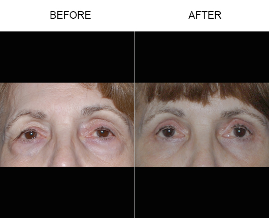 Lower Eyelid Surgery Results