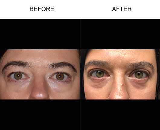 Lower Eyelid Surgery Before And After Lower Eyelid Surgery Before And After