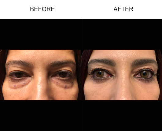 Lower Blepharoplasty Before And After