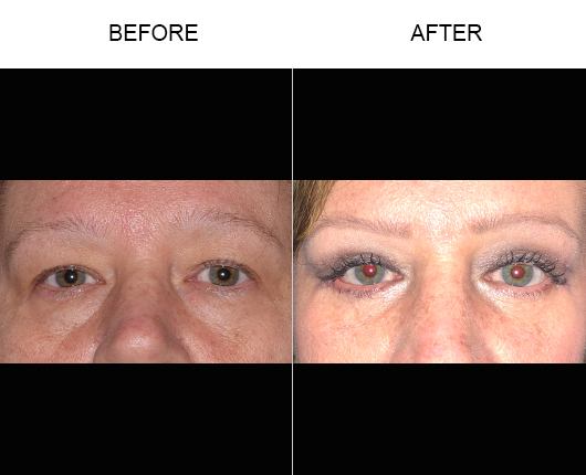 Blepharoplasty Before And After