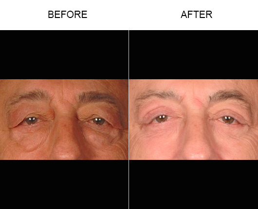 Upper Eyelid Surgery Before & After Upper Eyelid Surgery Before & After