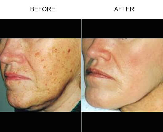 Skin Tightening Orlando  Laser Skin Tightening Florida