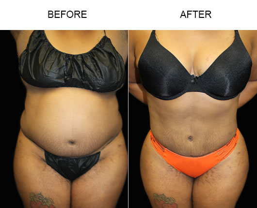 Liposuction Before And After