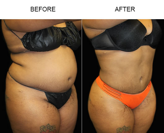 Liposuction Before & After