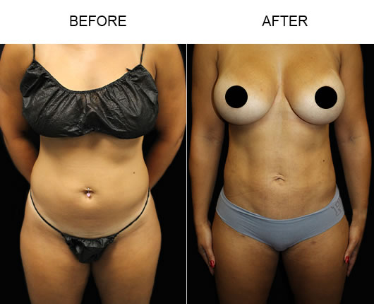 Before & After Liposuction