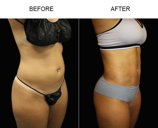 Liposuction Results