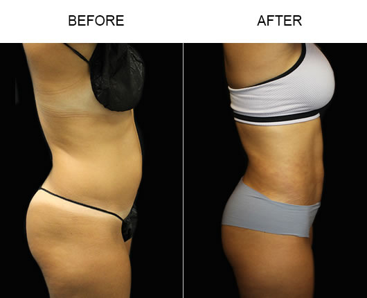 Liposuction Surgery Before And After