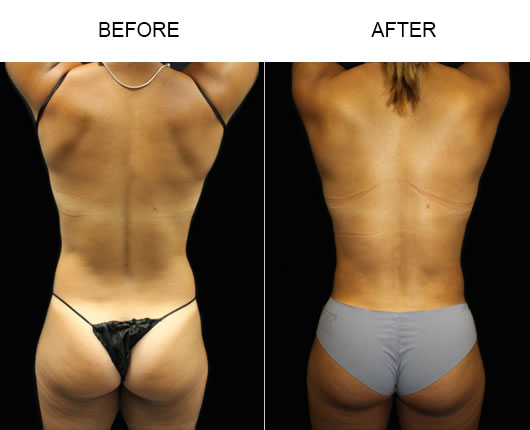 Florida Liposuction Results