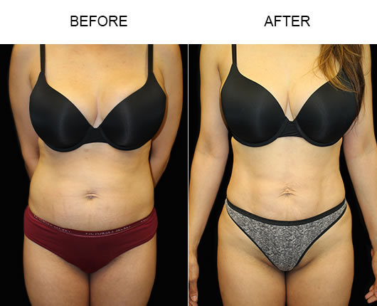 Liposuction Surgery Before & After