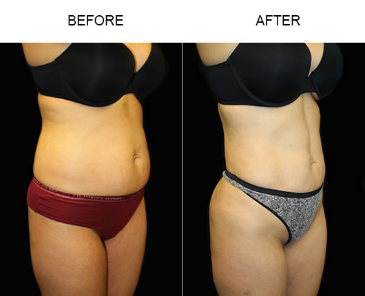 Before And After Liposuction Surgery