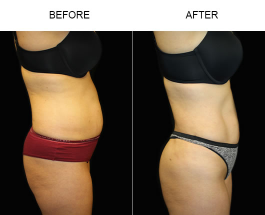 Before & After Liposuction Surgery