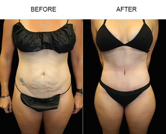 LowCut Tummy Tuck Before And After