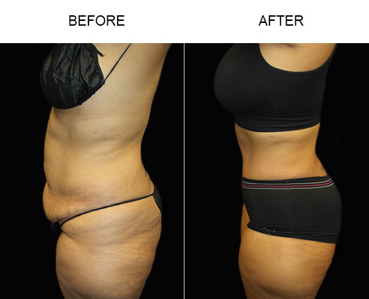 Low Cut Tummy Tuck Results